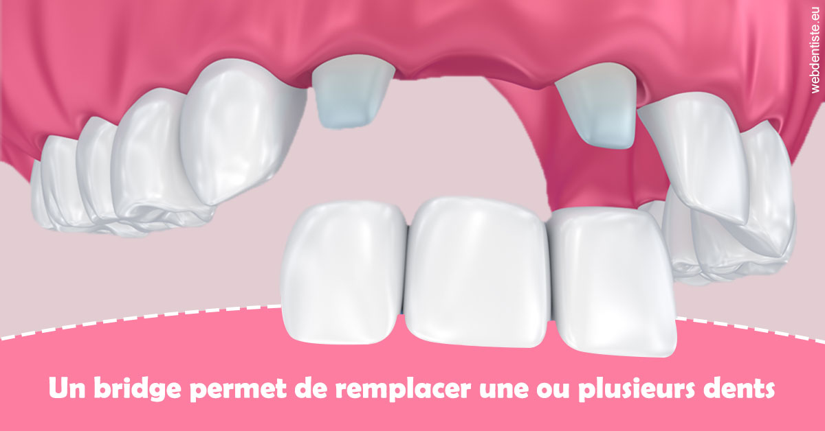 https://selarl-souffle-d-art-dentaire.chirurgiens-dentistes.fr/Bridge remplacer dents 2