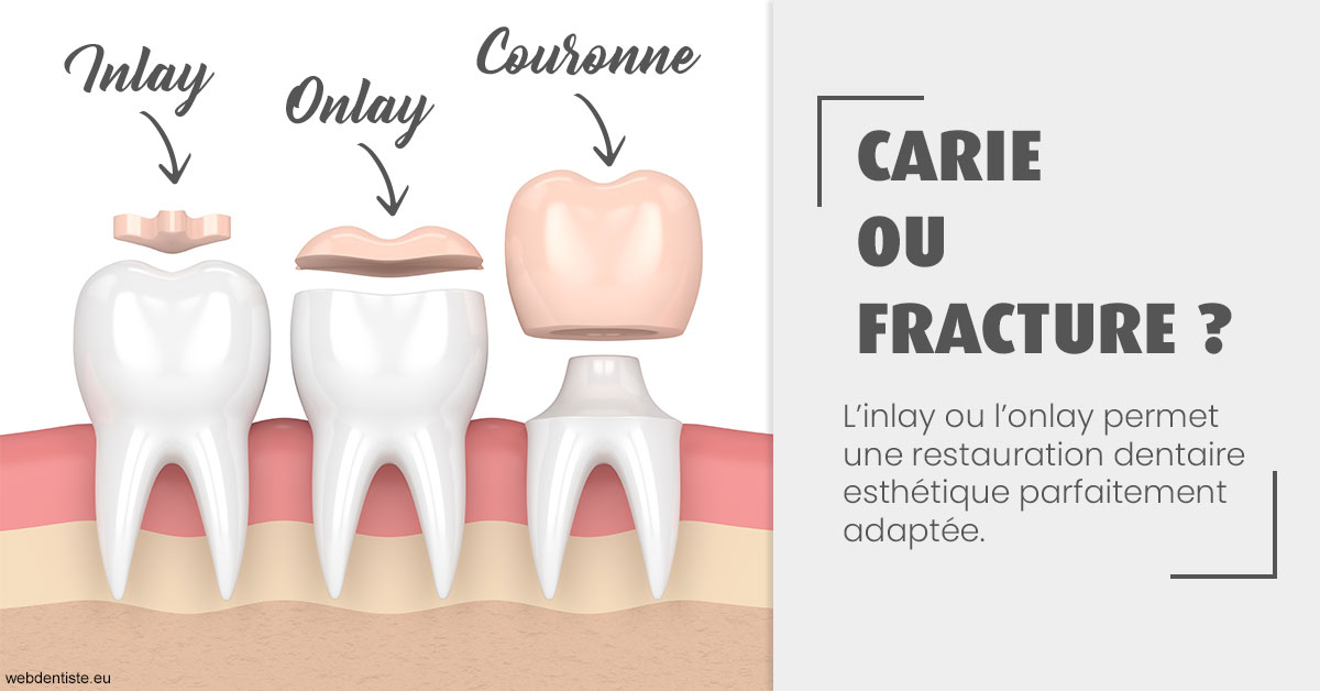 https://selarl-souffle-d-art-dentaire.chirurgiens-dentistes.fr/T2 2023 - Carie ou fracture 1
