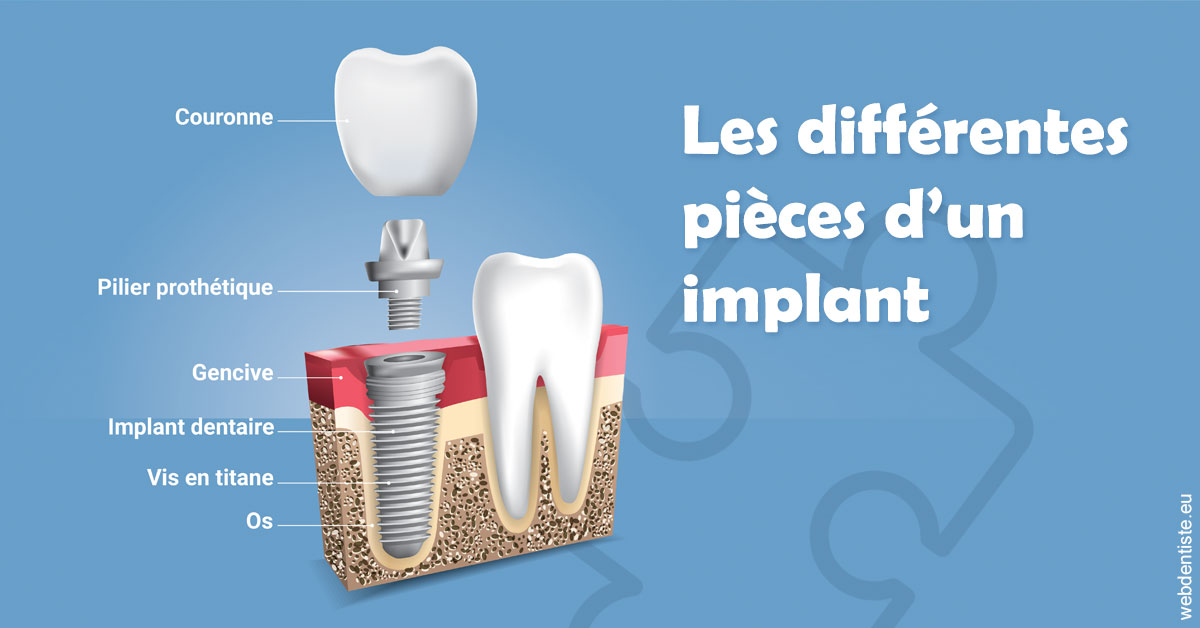 https://selarl-souffle-d-art-dentaire.chirurgiens-dentistes.fr/Les différentes pièces d’un implant 1